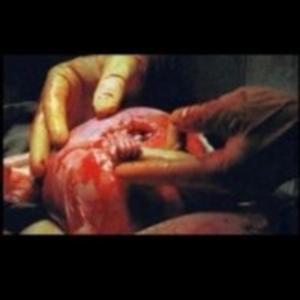 Abortion: A View from Outside the Uterus