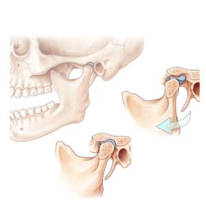 Trastornos Temporomandibulares