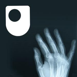 Rheumatoid arthritis - a long term condition - for iPod/iPhone