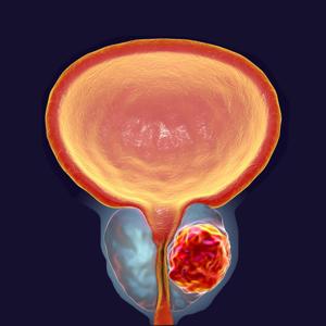 Novel Androgen Deprivation Treatment for Advanced Prostate Cancer