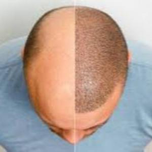 hair transplant guide