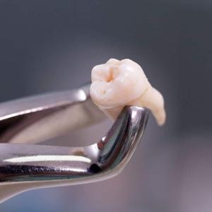 Instrucciones de exodoncia