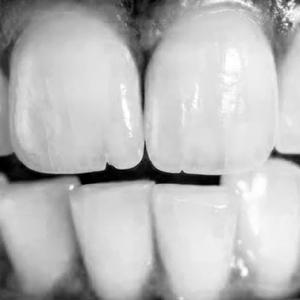 Dientes y Caries