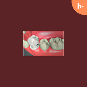 5 Signs It’s Time to Consider Dental Crowns in Newark