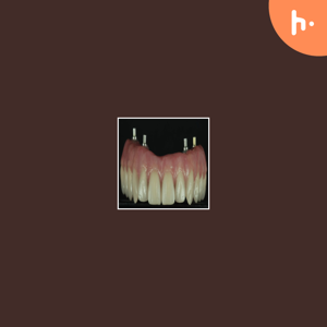 Teeth Whitening In Stoke On Trent