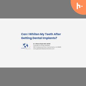 Can I Whiten My Teeth After Getting Dental Implants?