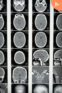 Podcast: Learn about neurosurgery from experts
