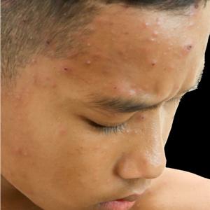 New Strategies and Best Practices in the Management of Pediatric Facial and Truncal Acne