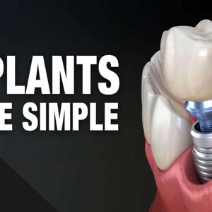 Implants Made Simple